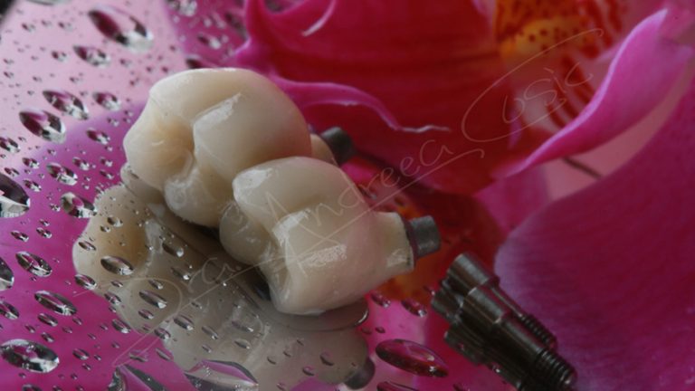 Coronas y prótesis dentales