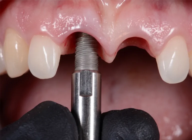 Implante dental en proceso de colocación